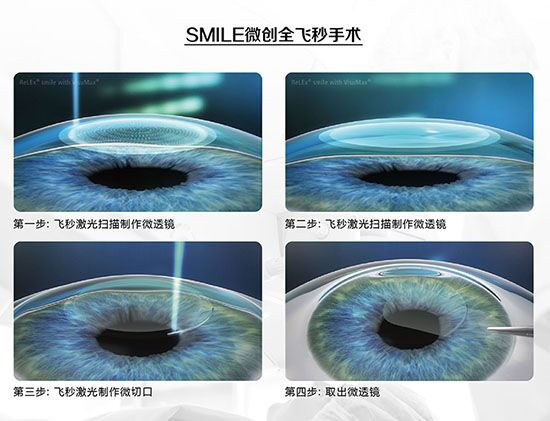 蔡司全飛秒、蔡司半飛秒近視手術(shù)與蔡司全飛秒flex手術(shù)