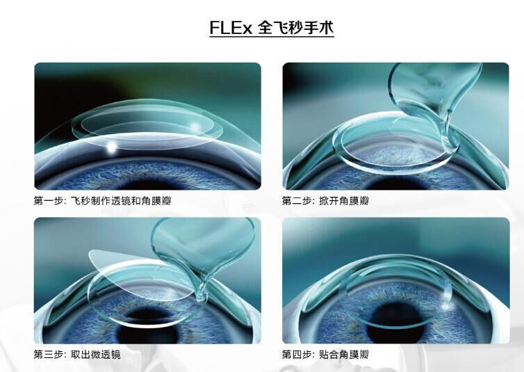 蔡司全飛秒、蔡司半飛秒近視手術(shù)與蔡司全飛秒flex手術(shù)