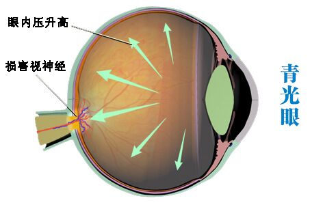 控制青光眼預防致盲的10大要點