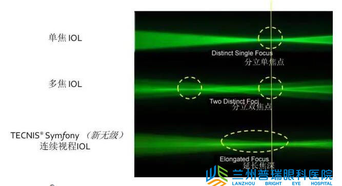 蘭州眼科醫(yī)院成功實(shí)施新無極變焦晶體植入術(shù)