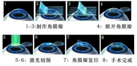 準(zhǔn)分子激光手術(shù)到底是怎么治 愈你的眼睛的？