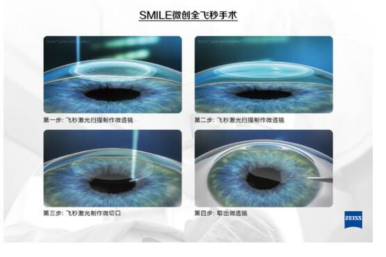 準(zhǔn)分子激光手術(shù)到底是怎么治 愈你的眼睛的？