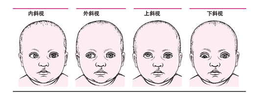 孩子有斜視做手術矯正有什么危險？