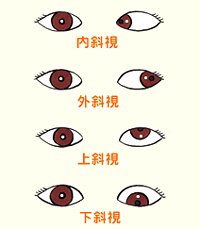 斜視檢查之注視性質(zhì)分類及檢查方法