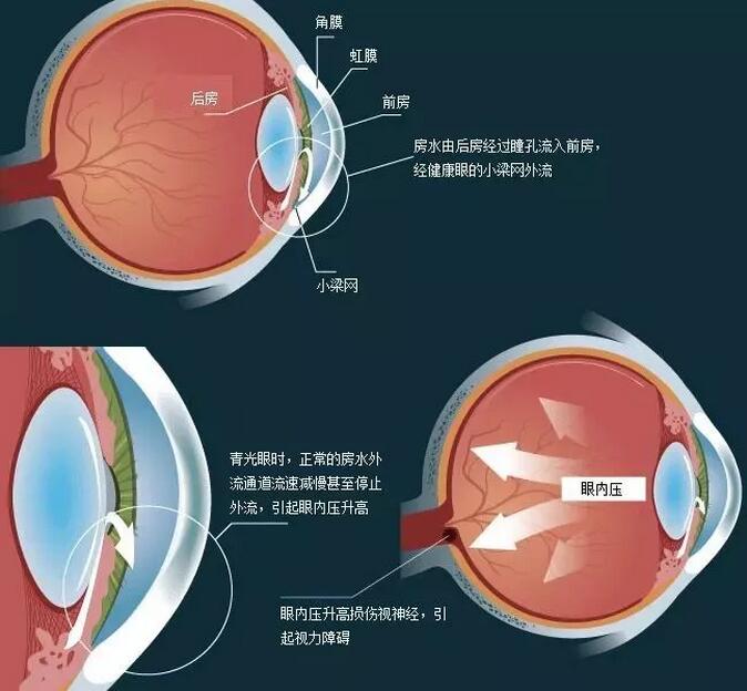 3.6號(hào)世界青光眼日：警惕視力小偷!