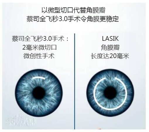 近視手術(shù)有哪幾種？你適合那種快看看