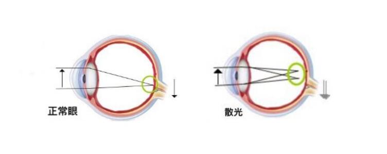 高度散光加近視可以做手術(shù)嗎？