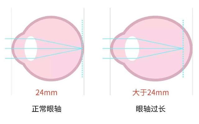 眼科醫(yī)生解密：哪些行為近視度數(shù)增長快