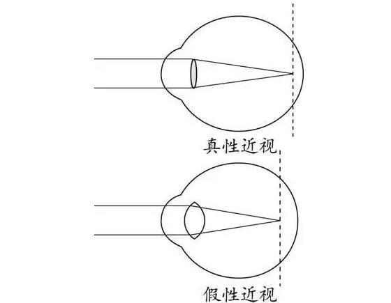 關于青少年近視的三個“小姿勢”